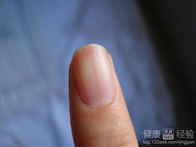 指甲上有小白斑意味著什麼疾病？