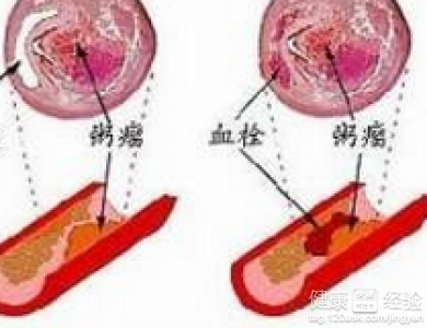 血管壁變厚吃什麼好