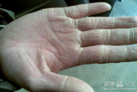 皲裂：食醋蘸手熱水泡腳能防治