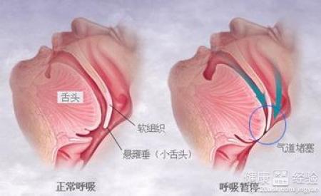 打呼噜也是病？4種食物竟能止鼾