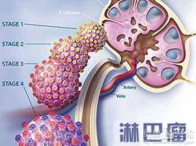 淋巴瘤吃什麼飲食上要怎樣調理