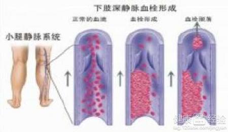 靜脈血栓患者吃什麼比較好