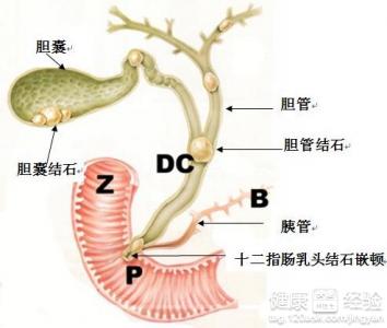 吃什麼容易得結石吃什麼可以防止結石