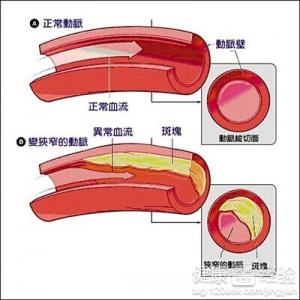 判斷力低下小心動脈硬化動脈硬化的食療方