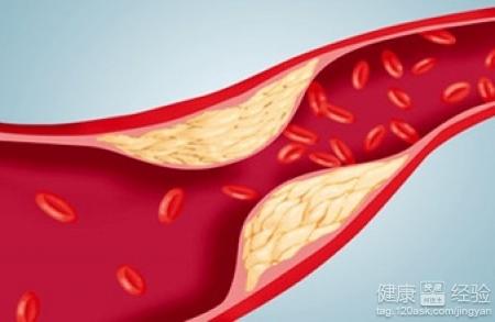 五種食療方法防動脈硬化