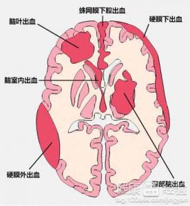 腦供血不足要多吃優質蛋白