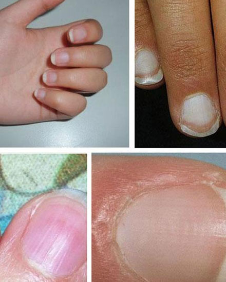 指甲凹凸不平暗示什麼疾病