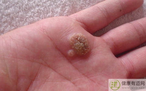 瘊子是什麼